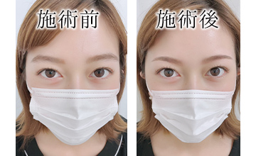 ROAK（ローク）施術例　アイブロウ例1