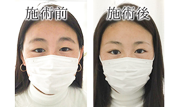 ROAK（ローク）施術例　アイブロウ例3