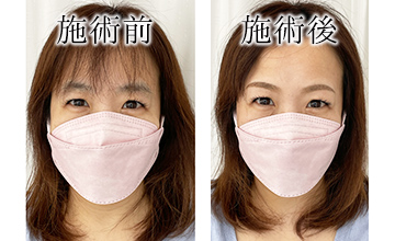 ROAK（ローク）施術例　アイブロウ例4