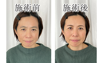 ROAK（ローク）施術例　アイブロウ例5