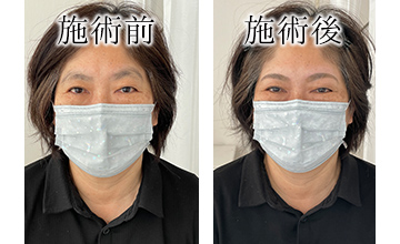 ROAK（ローク）施術例　アイブロウ例6